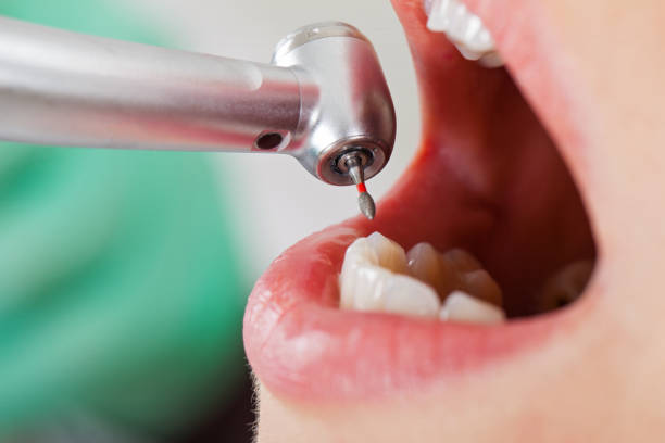 Best Emergency Root Canal Therapy in Hammond, LA